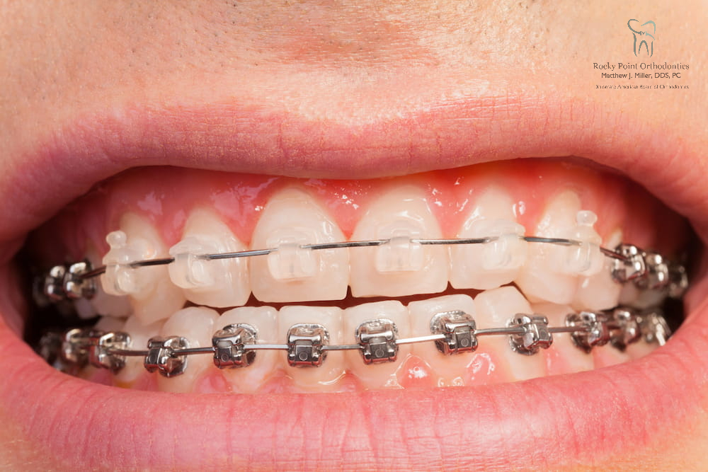 Braces Cost in Rocky Point, NY