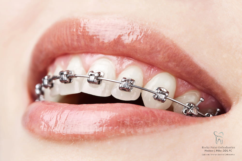 Braces Cost in Rocky Point, NY