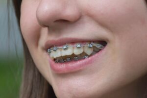 Close-up of a smiling patient showing metal braces on teeth – braces for overbite in rocky point, ny.