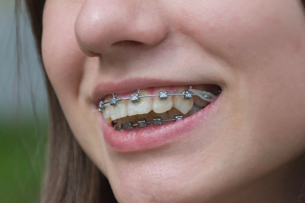 Close-up of a smiling patient showing metal braces on teeth – braces for overbite in rocky point, ny.
